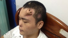 Surgeons at a hospital will transplant a new nose grown on a patient’s forehead to his nasal spot in Fuzhou City, east China’s Fujian Province.